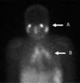 Gallium 67 Scan (Diagnosis of Sarcoidosis)