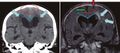Normal pressure hydrocephalus versus atrophy