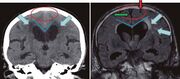 Normal pressure hydrocephalus versus atrophy