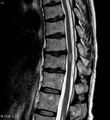 MRI image of transverse myelitis