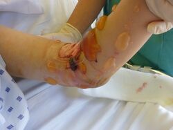 Signs and symptoms of Antiphospholipid syndrome