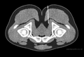 CT image guided injection of the pudendal nerve
