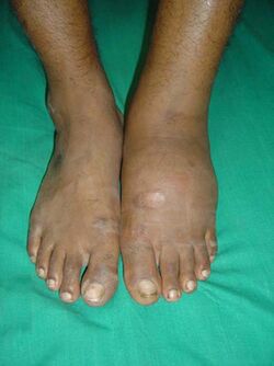 Charcot arthropathy