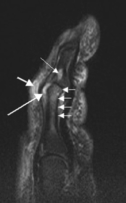 Psoriatic arthritis digit