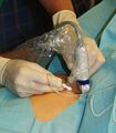 Femoral nerve block