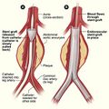 Endovascular Aneurysm Repair