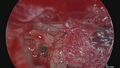 Endoscopic view of Stapedotomy