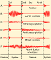 Phonocardiograms from normal and abnormal heart sounds