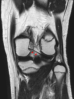 Ligamentum wrisberg
