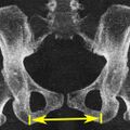 Intertuberous diameter