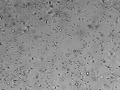 Sperm cells in the urine sample of a 45-year-old male patient who is being followed with the diagnosis of benign prostate hyperplasia.