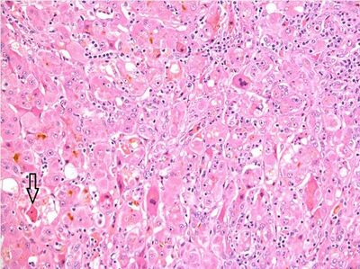 Histopathology of acute hepatitis