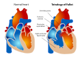 Tetralogy of Fallot