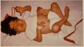 List of conditions with craniosynostosis