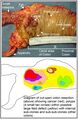 Resected colon segment with cancer and nearby polyps