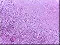 Tuberculous lymph node with caseating granuloma 40X