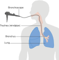 Bronchoscopy