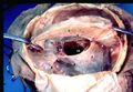 Inferior sagittal sinus