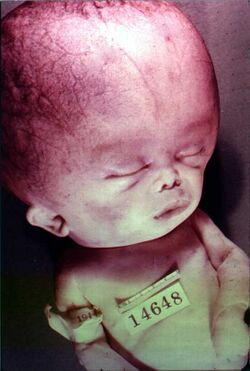 Hydrocephalus