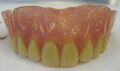 Complete denture example
