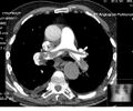Saddle Pulmonary Embolism
