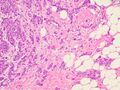 Histopathology of invasive ductal carcinoma, intermediate magnification