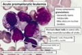 Cytology of acute promyelocytic leukemia, annotated