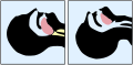 Diagram showing tongue blocking the airway
