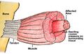 Compartment syndrome in muscle