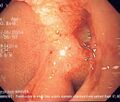 Duodenal ulcer