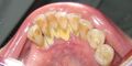 Mandibular anterior calculus