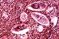 Schistosomiasis haematobia