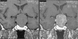 Acromegaly pituitary macroadenoma