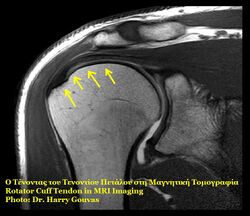 Rotator cuff on MRI imaging