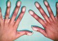 Congenital Heart Case 133