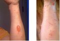 Urushiol induced contact dermatitis