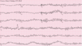 EKG depiction of ventricular fibrillation (no organized rhythm)