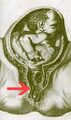 Cord Prolapse