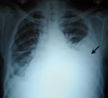 Mediastinal shift