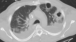 CT chest in pneumonia with abscesses caverns and effusions