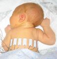 Neonate with electrical impedance tomography electrodes
