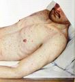 Epidemic Typhus Macular Rash
