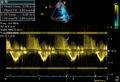 Transthoracic echocardiogram