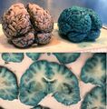 Gross pathology of brain treated with Methylene Blue