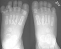 Toe