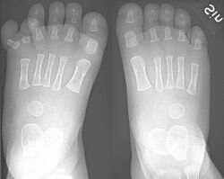 X-ray of feet in polydactyly