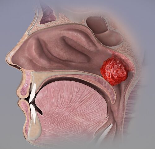 Adenoid hypertrophy