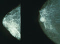 Breast implant