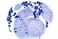 Vasculitic neuropathy - plastics - low magnification