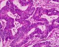 Adenocarcinoma recti (well differentiated)